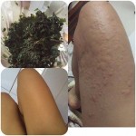 Bạn T.L đã hết mẩn ngứa mề đay sau 5 phút bôi lá kinh giới trộn rượu.