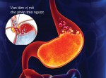 Nên lưu ý khi bị hội chứng trào ngược dạ dày - thực quản
