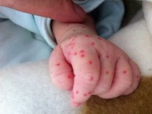 Phân biệt sốt xuất huyết và sốt phát ban