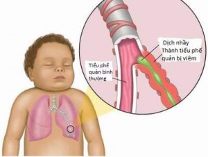 Mùa lạnh phòng bệnh viêm đường hô hấp cho trẻ