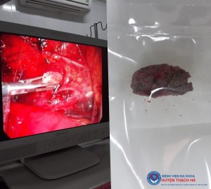 Hình ảnh viên sỏi niệu quản của bệnh nhân T.