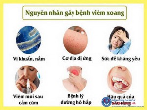 Các nguyên nhân gây viêm xoang.