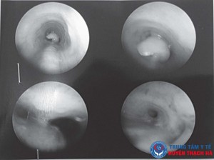 Dị vật là một nửa hạt lạc nằm ngay ở ngã ba khí quản của bé T.T.T, gây bít tắc đường thở