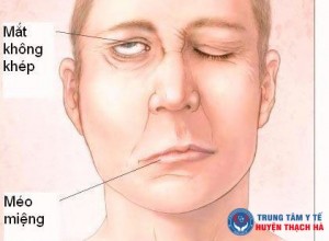 Giữ ấm trong ngày lạnh để phòng ngừa liệt mặt, méo miệng