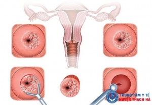 Áp lạnh cổ tử cung thường tiến hành cho bệnh nhân mắc viêm lộ tuyến cổ tử cung cấp độ 2 và 3