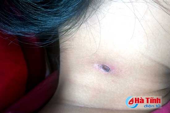 Bệnh nhi Trần Lê Anh Thơ xuất hiện nhọt đã bị khô do nhiễm trùng ở vùng cổ. (Ảnh do bác sỹ Trần Anh Pháp cung cấp)