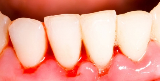 Điều trị chảy máu chân răng bằng những bài thuốc tự nhiên