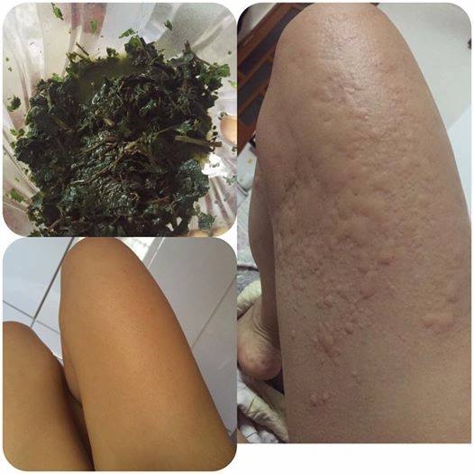 Bạn T.L đã hết mẩn ngứa mề đay sau 5 phút bôi lá kinh giới trộn rượu.