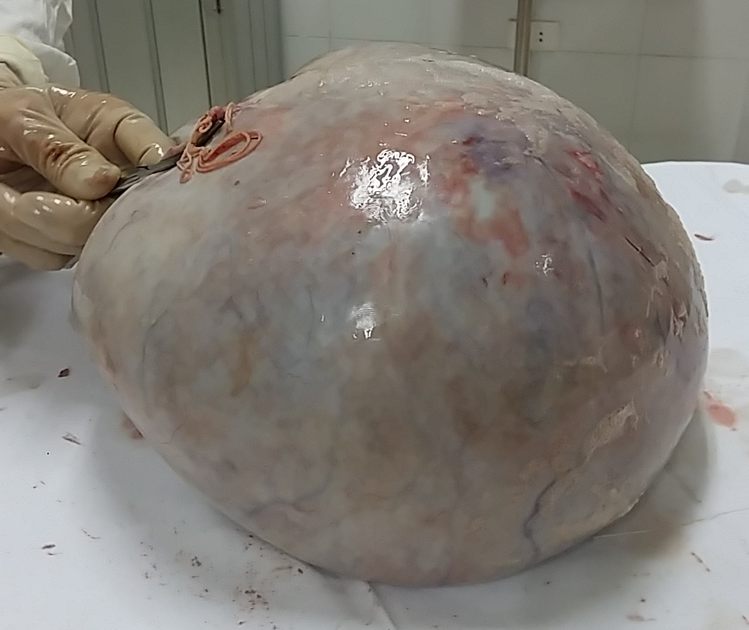 Khối u được lấy ra nặng gần 10kg.
