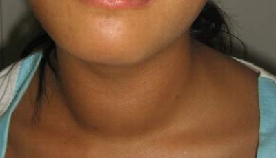 Khác nhau giữa Basedow và bướu giáp hỗn hợp?