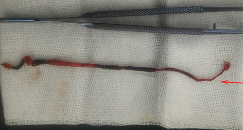 Đoạn huyết khối sau khi bóc tách. Ảnh: H.M