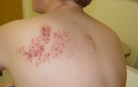 Ðể giảm nguy cơ biến chứng sau mắc Zona