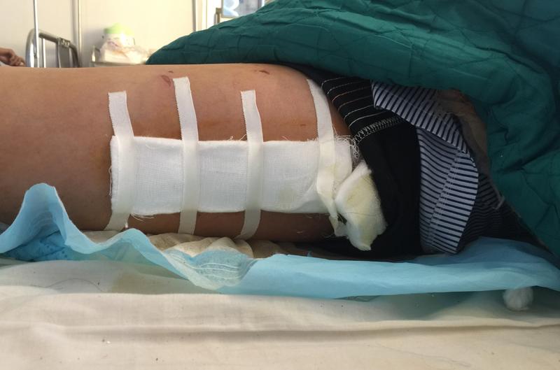 Bệnh nhân Bình có thể được xuất viện trong vài ngày tới