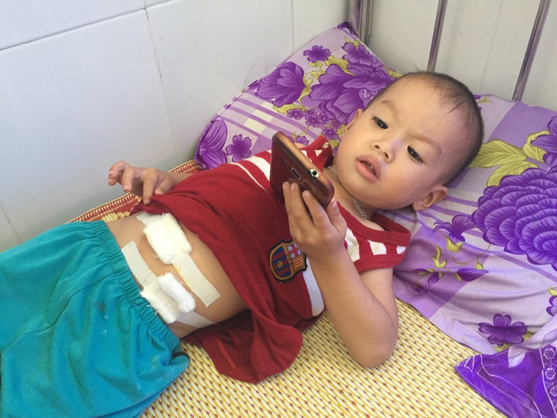 Mổ nội soi thành công cho bệnh nhi 31 tháng tuổi bị viêm ruột thừa cấp
