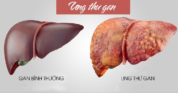 Thông báo về việc Khám sàng lọc ung thư gan