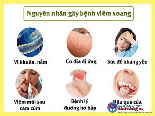 Các nguyên nhân gây viêm xoang.