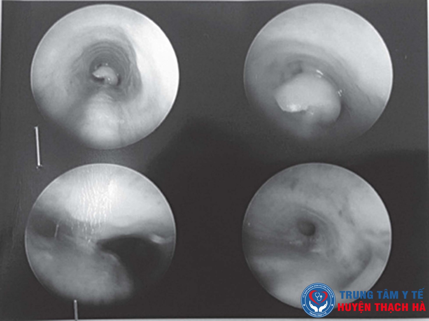 Dị vật là một nửa hạt lạc nằm ngay ở ngã ba khí quản của bé T.T.T, gây bít tắc đường thở