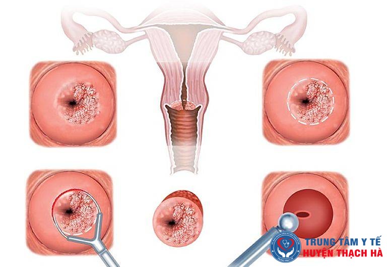 Áp lạnh cổ tử cung thường tiến hành cho bệnh nhân mắc viêm lộ tuyến cổ tử cung cấp độ 2 và 3