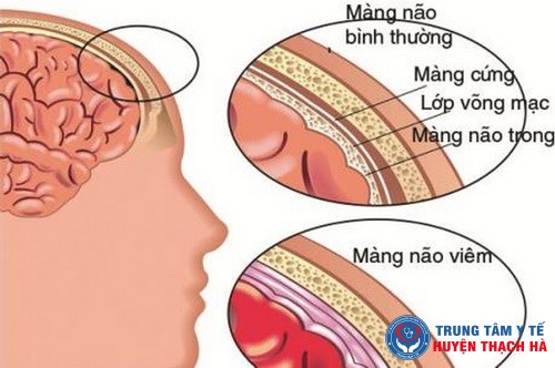 Tiếp cận chẩn đoán và điều trị viêm màng não - viêm não nhiễm trùng