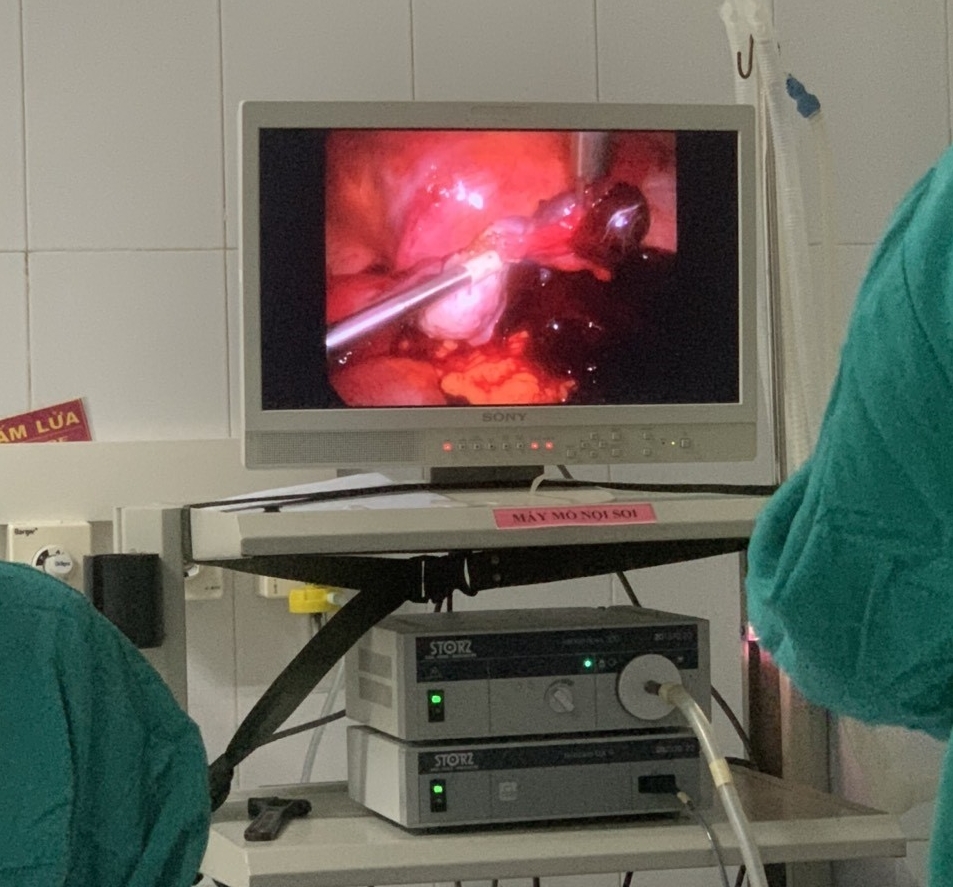 Mổ cấp cứu kịp thời bệnh nhân chữa ngoài tử cung vỡ